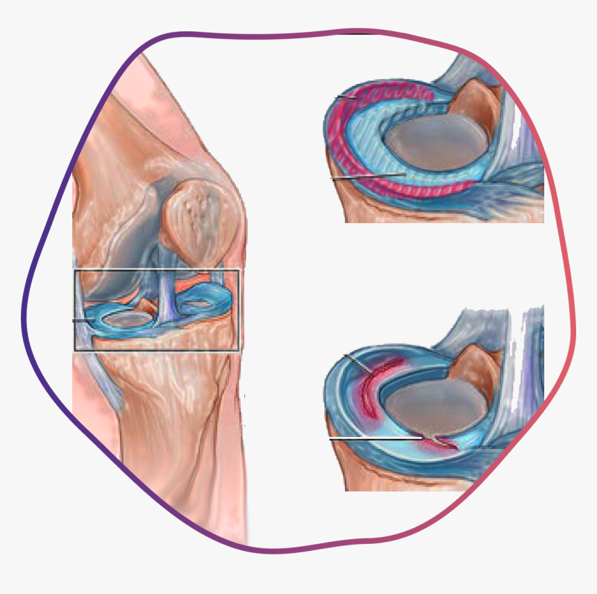 Meniscus Tears, HD Png Download
