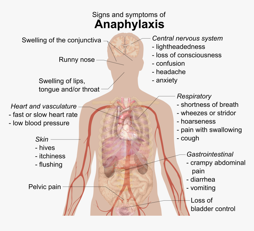 Signs And Symptoms Of Anaphylaxis - Anaphylaxis Symptoms, HD Png Download