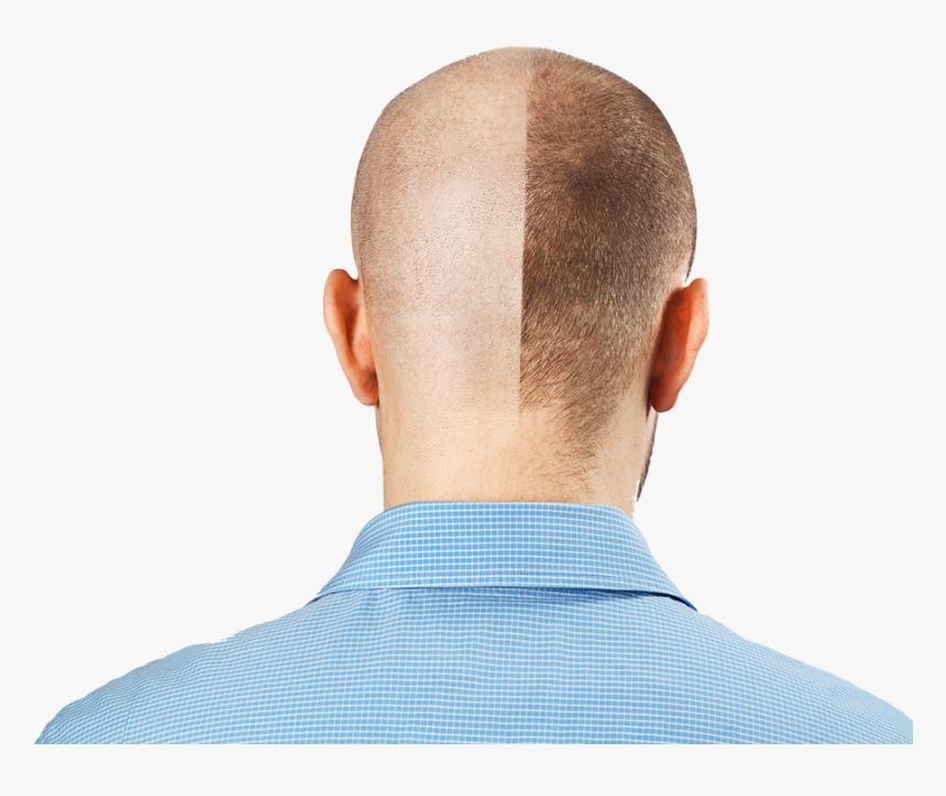 Hair Transplant Stock, HD Png Download