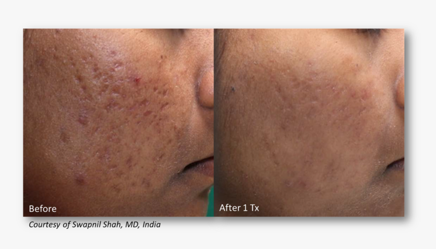 Shah - Lutronic Genius Acne Scarring, HD Png Download