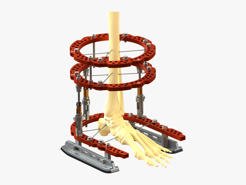 External Fixation Image3 - Mechanical Puzzle, HD Png Download