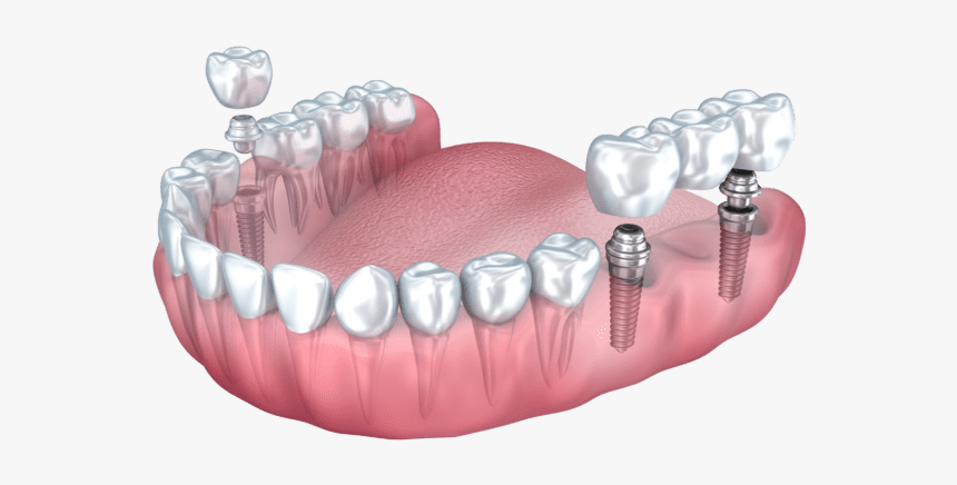 Dental Implant Benefits Summit Nj - Multiple Dental Implants, HD Png Download