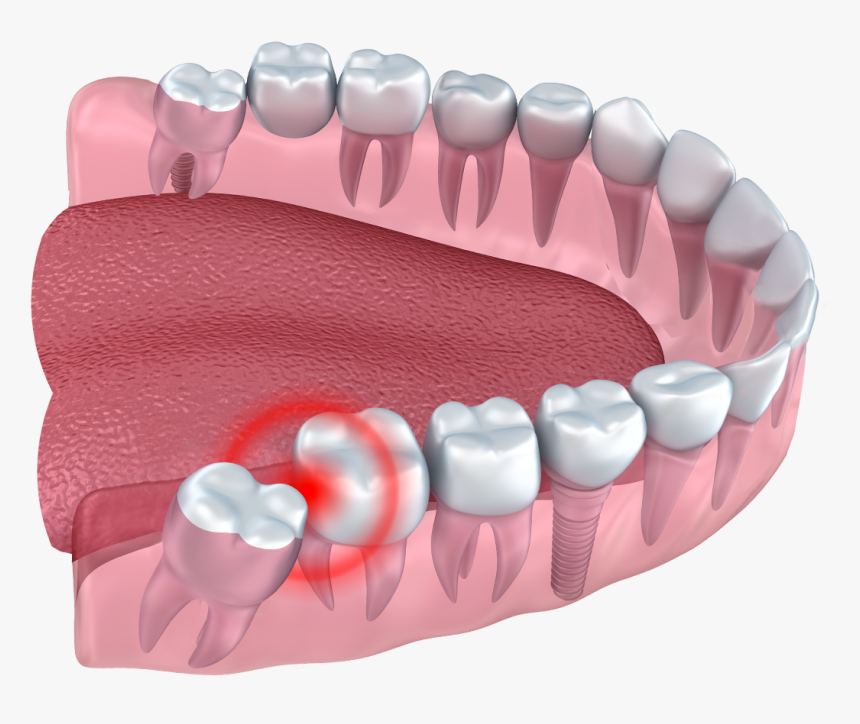 Wisdom Teeth Impacted - Teeth Are Wisdom Teeth, HD Png Download