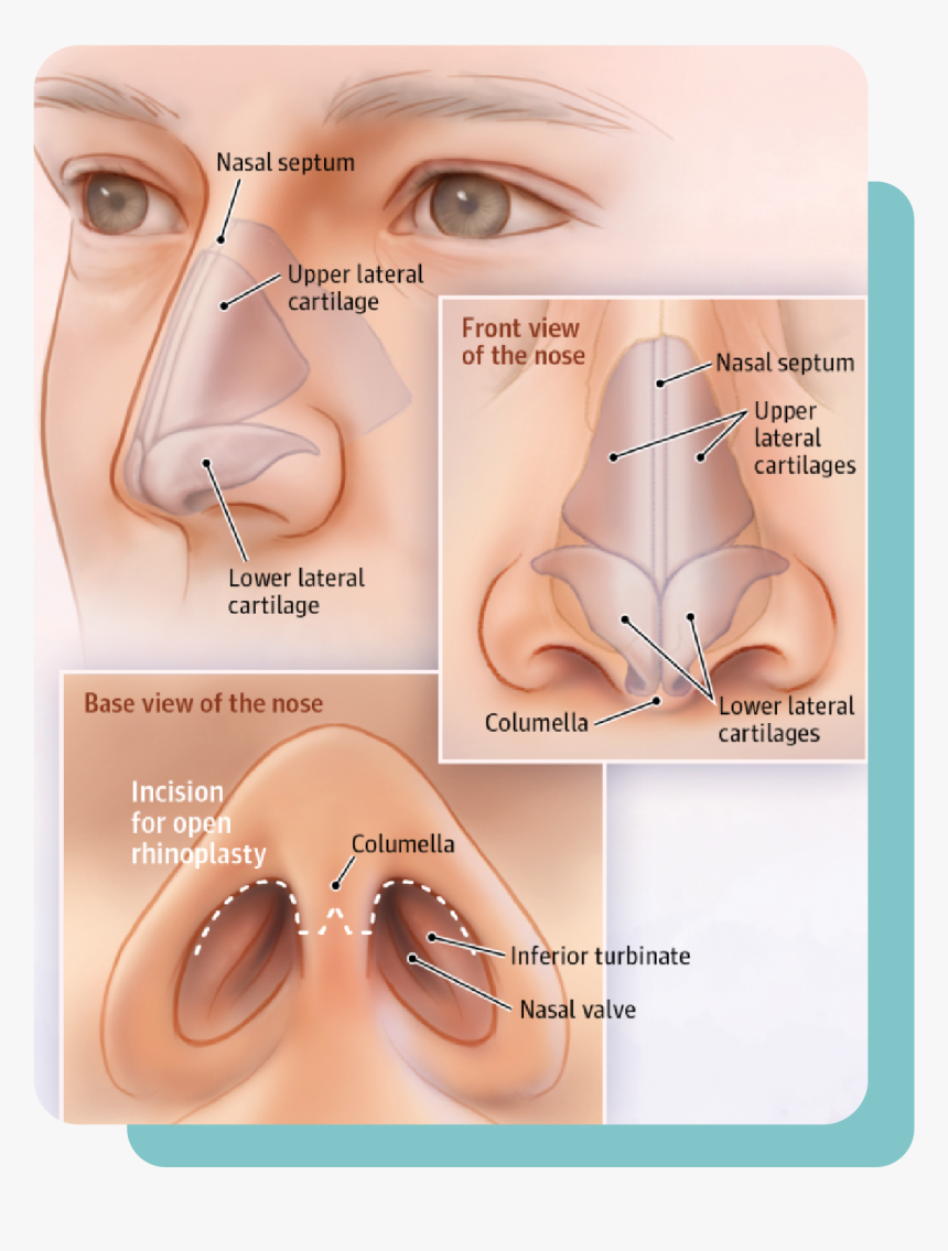 Lower Lateral Cartilage Nose Job, HD Png Download