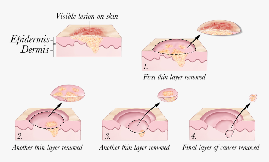 © 2010 Terese Winslow - Skin Cancer Treatment, HD Png Download