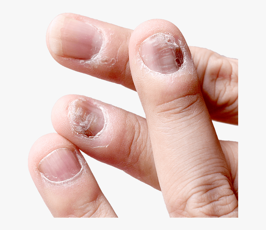 Broken Nails - Loceryl Nail Lacquer 2.5 Ml, HD Png Download