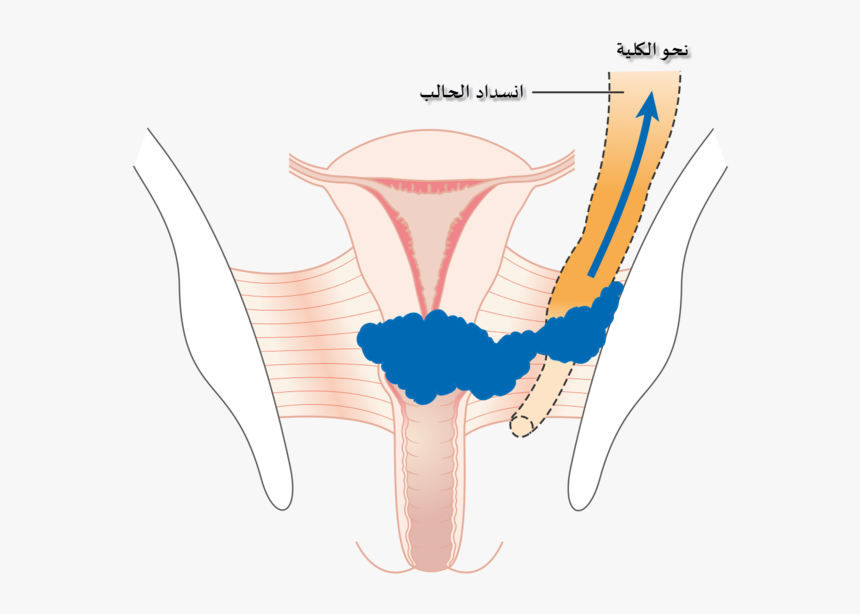 Diagram Showing Stage 3b Cervical Cancer Cruk 226-ar - Cervical Cancer Causing Hydronephrosis, HD Png Download