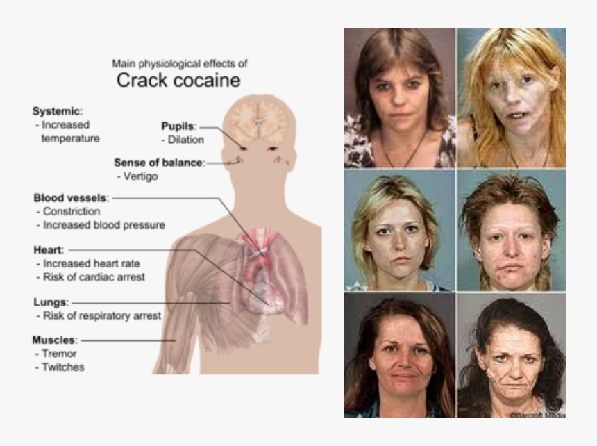Picture - Effects Of Crack Cocaine, HD Png Download