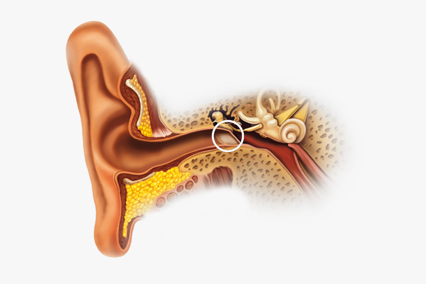 Calcification Of Ear Canal, HD Png Download