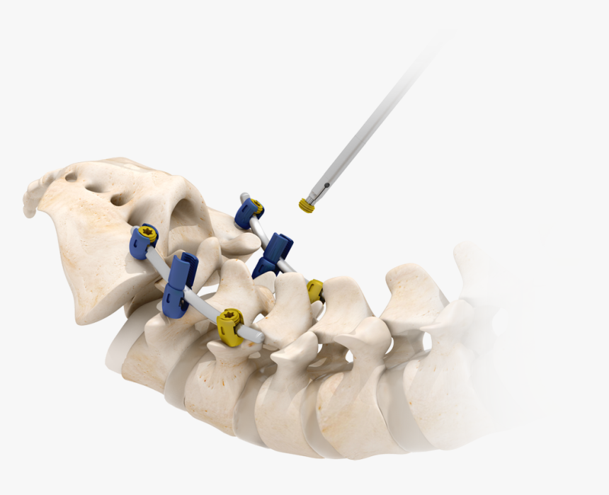 Picture - Screw Degenerative Spine, HD Png Download