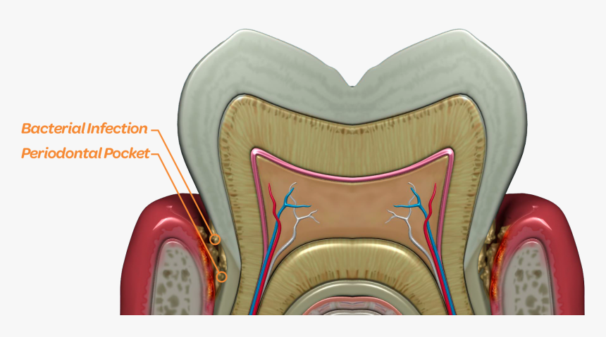 Bacteria Thrive Deep Below The Gum Line In The Periodontal - Tooth, HD Png Download