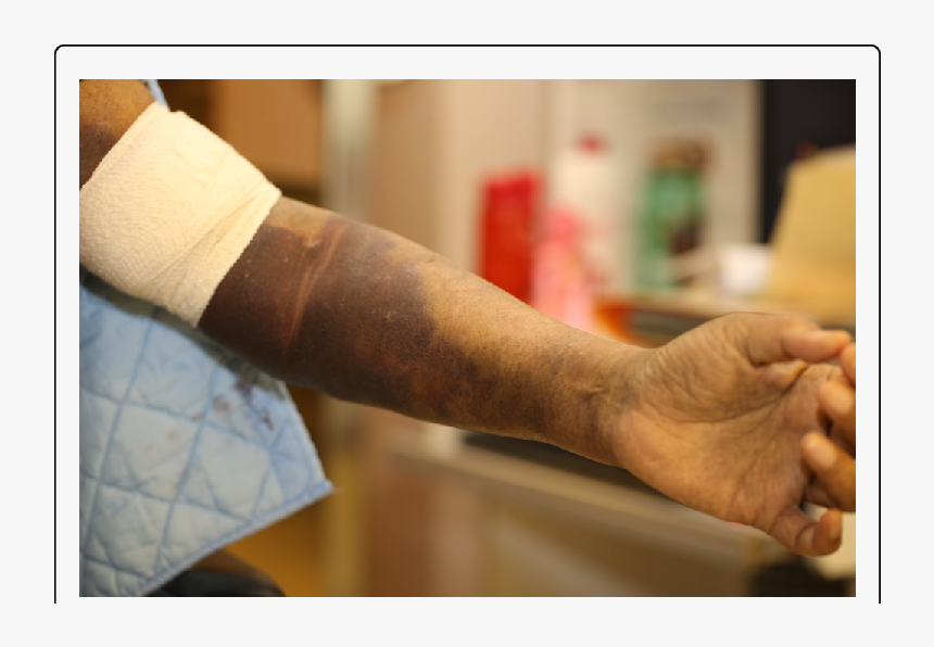 Blood Test Complications Hematoma, HD Png Download