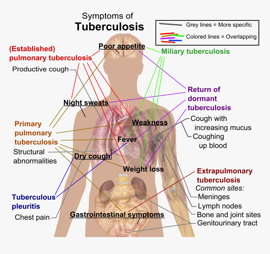 Tuberculosis Symptoms - Symptoms Of Tuberculosis, HD Png Download