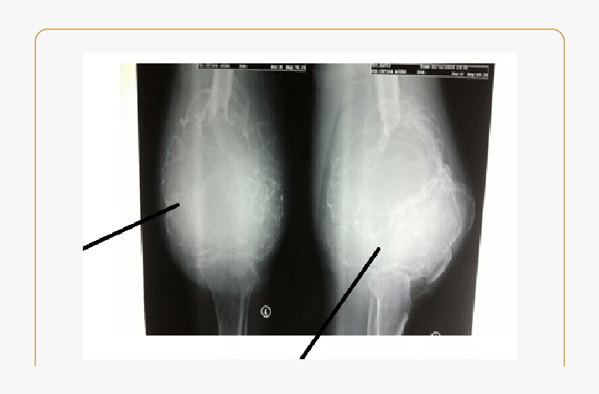Ap And Lateral Radiographs Of The Left Knee Joint - Medical Radiography, HD Png Download