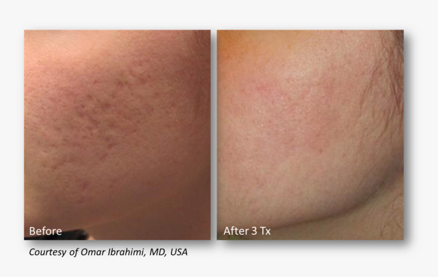 Ibrahimi - Vivace Microneedling Rf, HD Png Download