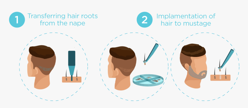 Hair Transplantation, HD Png Download