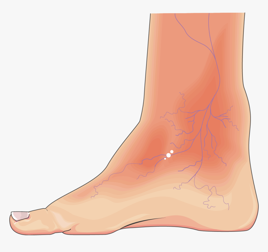 Diabatic-foot, HD Png Download