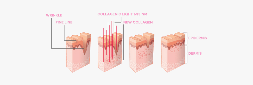 Dr Muller Collagenic Light - Red Light Therapy Before, HD Png Download