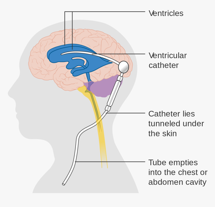 Shunt In Spine Cervical, HD Png Download