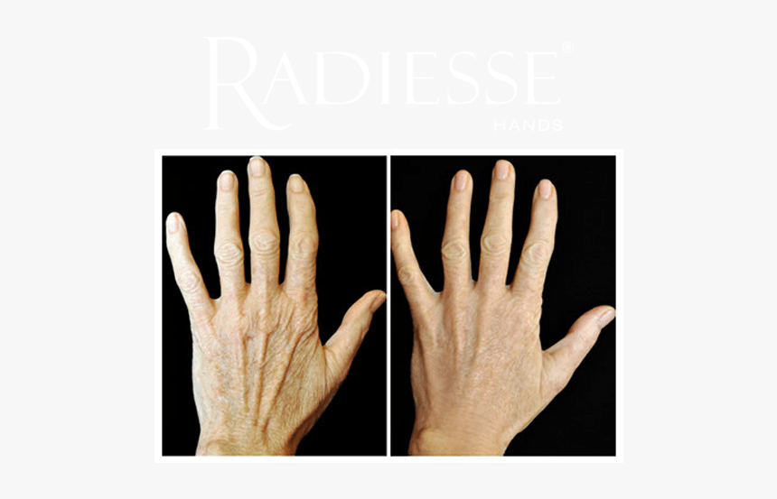 Before And After Treatment With Radiesse® Hands - Ácido Hialurônico Nas Mãos, HD Png Download
