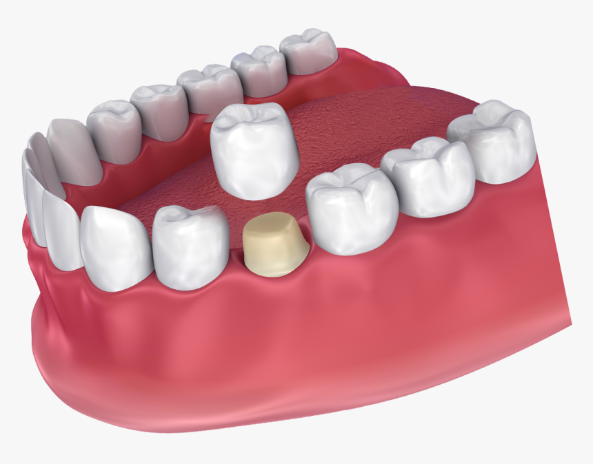 How A Dental Crown Fits - Crown Dental, HD Png Download