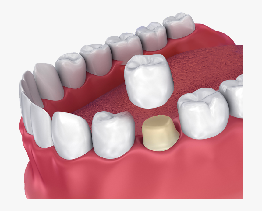 Dental Crown Hovering Over Prepared Tooth - Crown Dental, HD Png Download