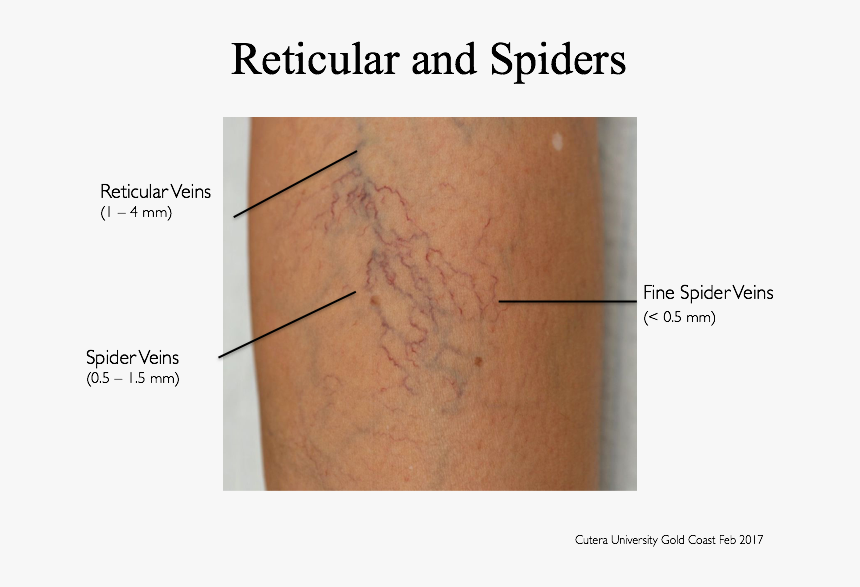 What Not To Treat Hits The Spot - Spider Vein Treatment Cutera, HD Png Download