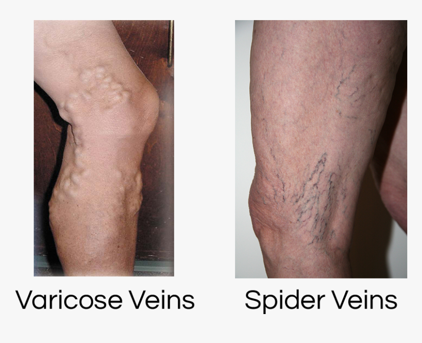 Spider Veins, HD Png Download