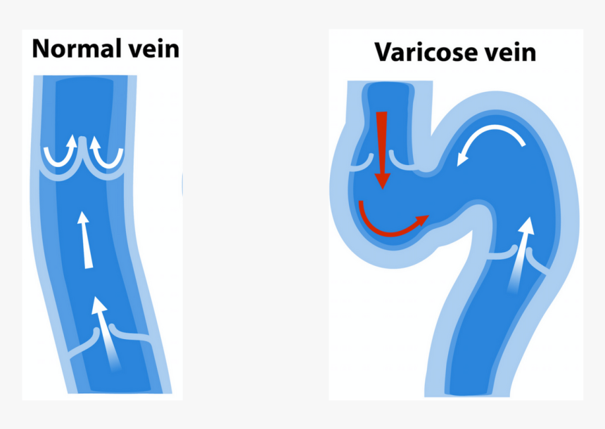 Varicose Vein Symptoms - Normal Vein Vs Varicose Vein, HD Png Download
