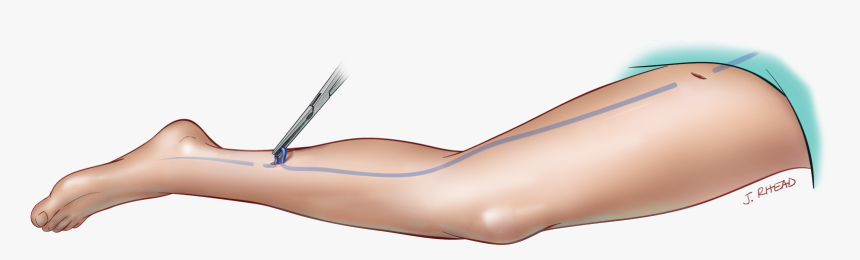 Treatment-vein Stripping - Leather, HD Png Download