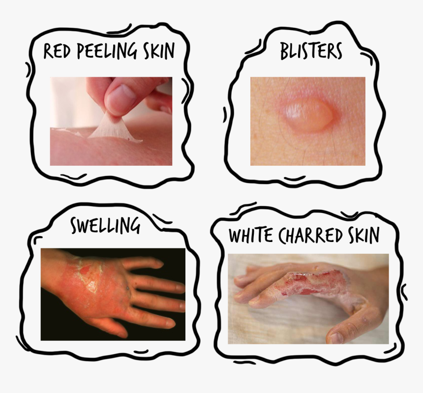 Scald Burn, HD Png Download