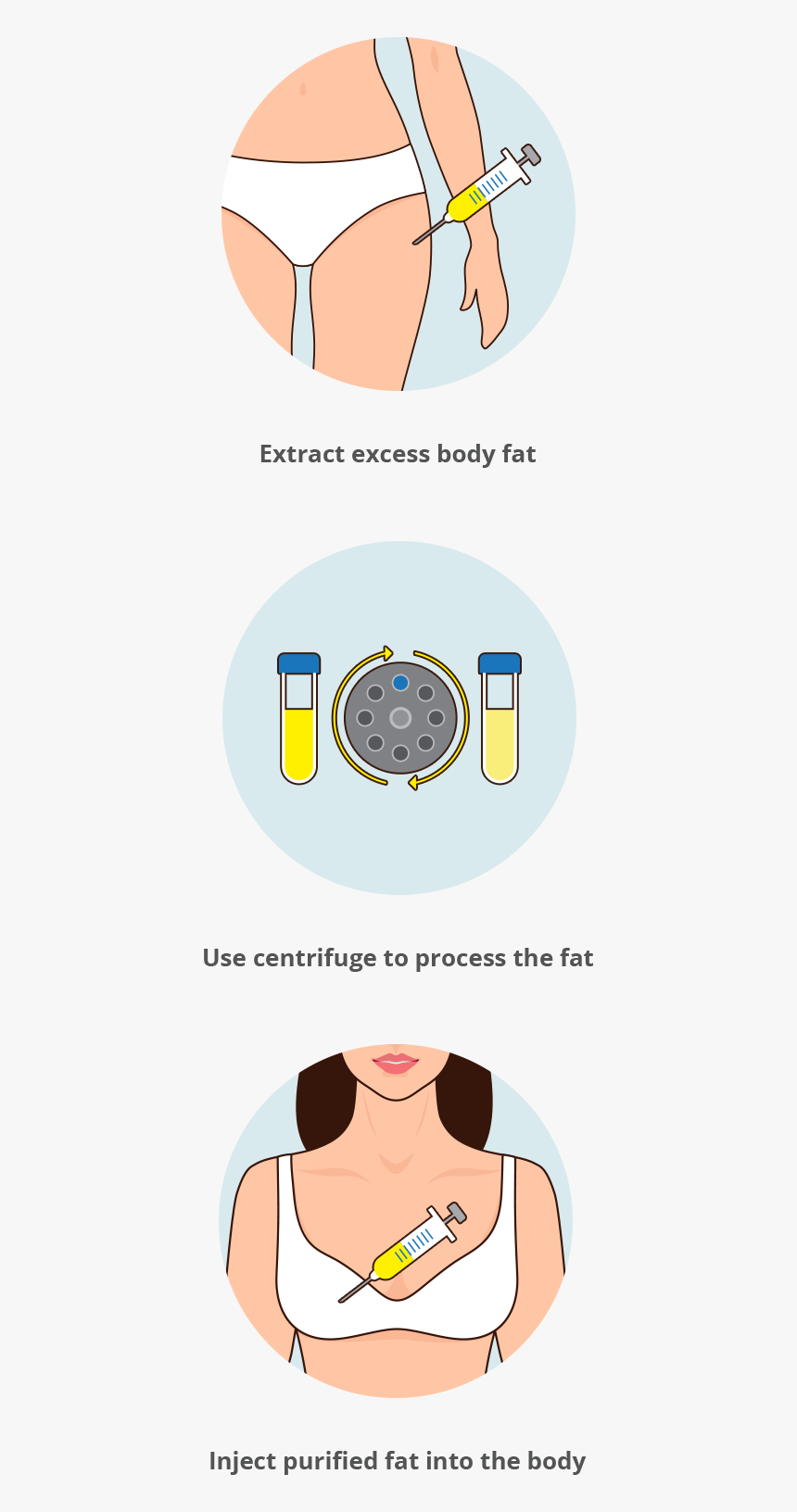 Breast Augmentation Fat Transfer - Circle, HD Png Download