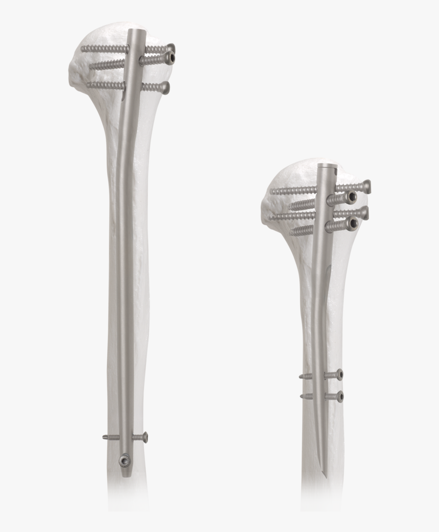 With A Proximal Bend Of 6 Degrees, The Aos Short Nail - Humerus Intramedullary Nail, HD Png Download