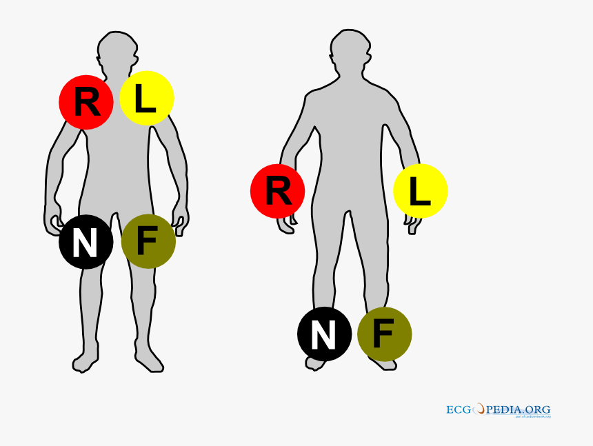 Ecg Limb Leads Colour, HD Png Download