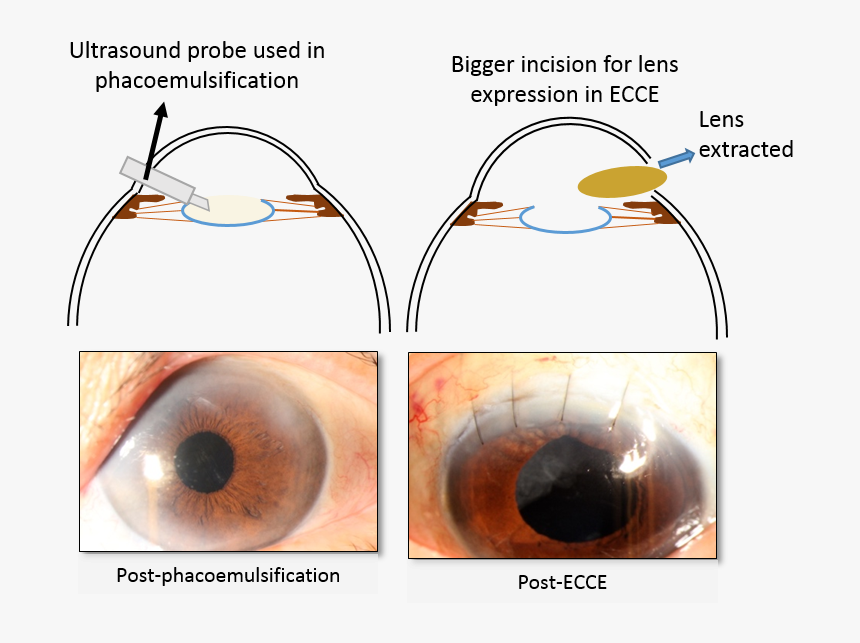 Cataract Surgery - Ecce Cataract Surgery, HD Png Download