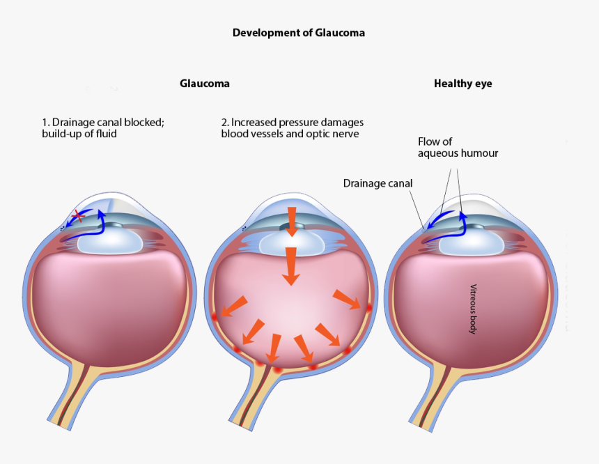 Development Of Glaucoma - Glaucoma Vs Healthy Eye, HD Png Download