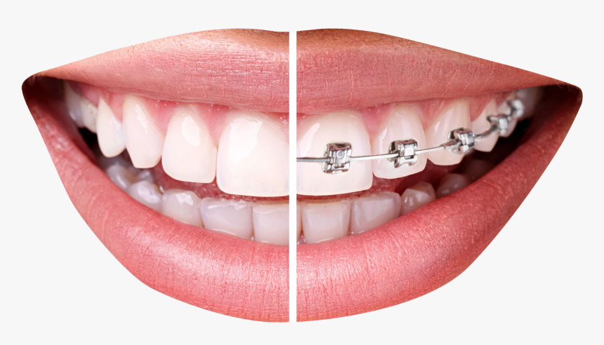 Thumbs Up Png Transparent Image - Teeth Braces Png, Png Download