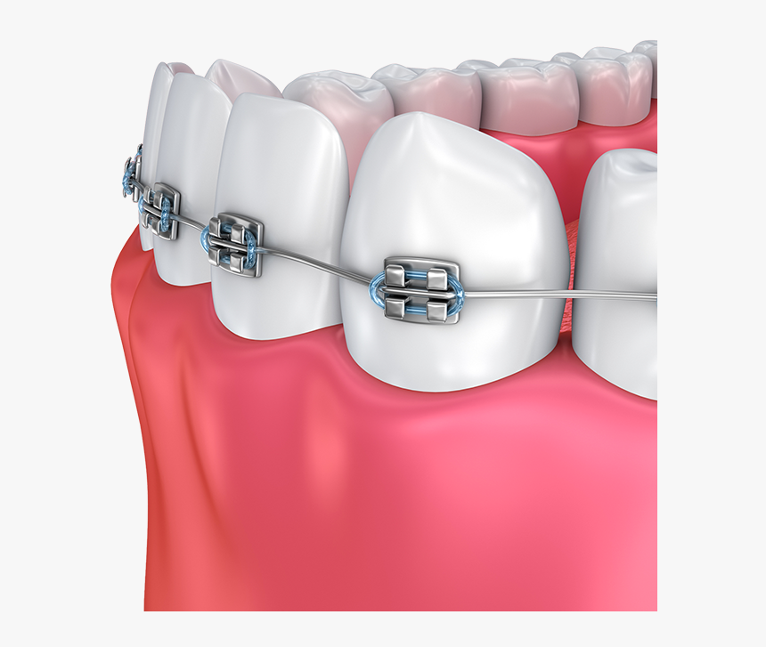 Haltom Orthodontics - Dental Braces, HD Png Download