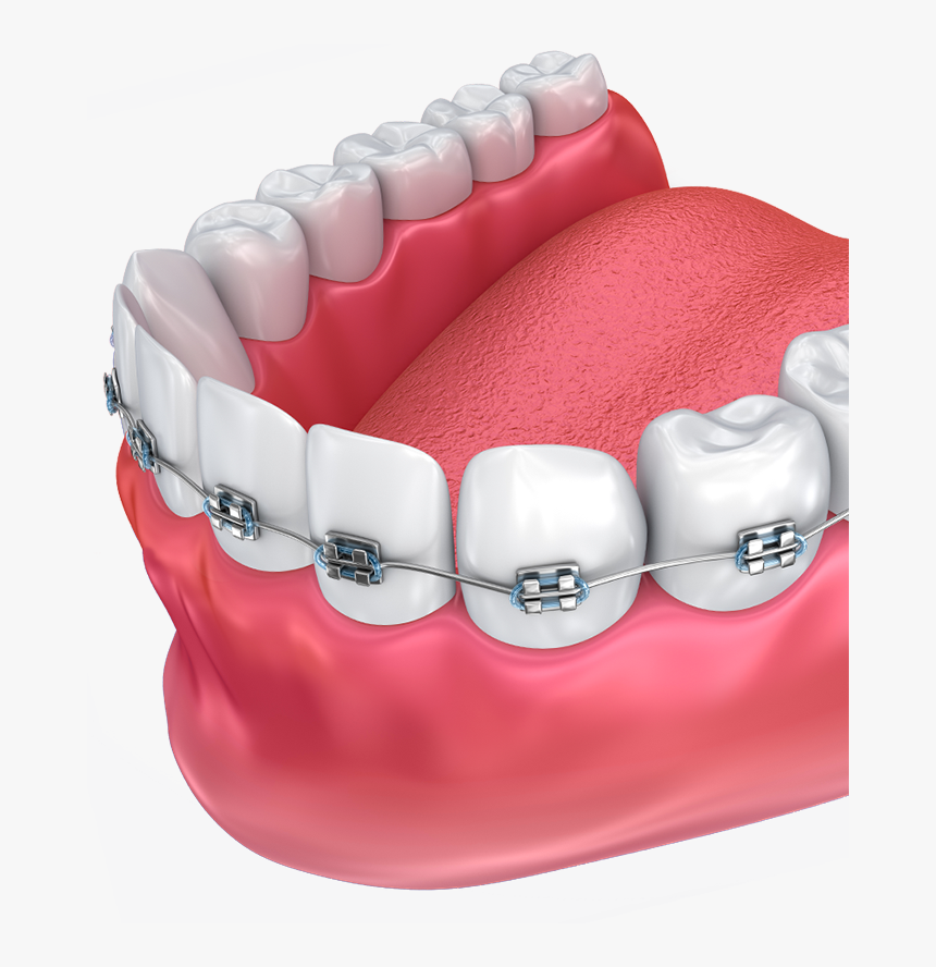 Haltom Orthodontics - Tooth Orthodontics Png, Transparent Png