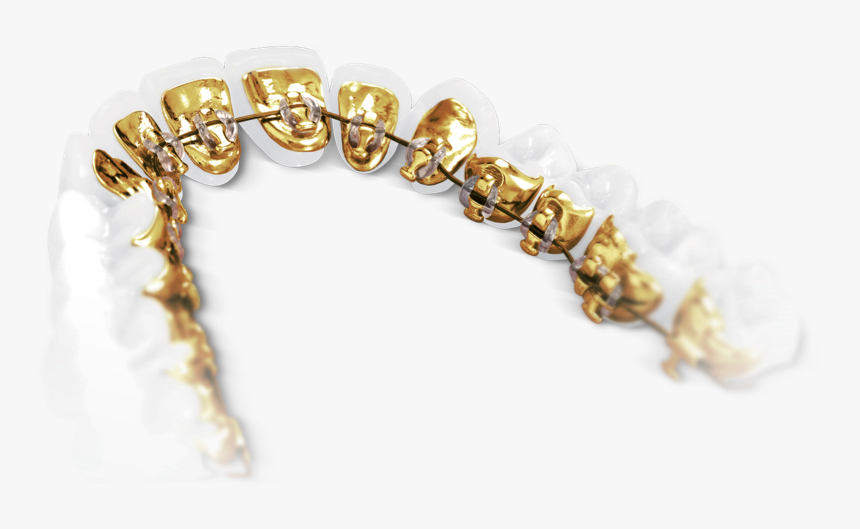 Lingual Braces Sydney - Lingual Incognito, HD Png Download