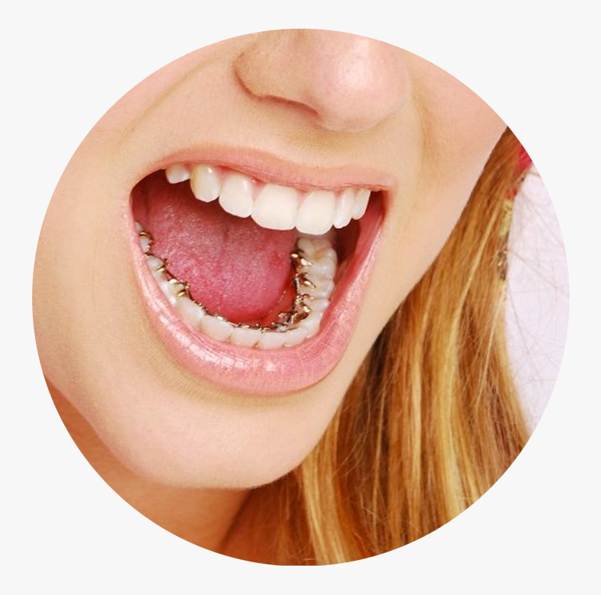 Teeth Inside Braces, HD Png Download