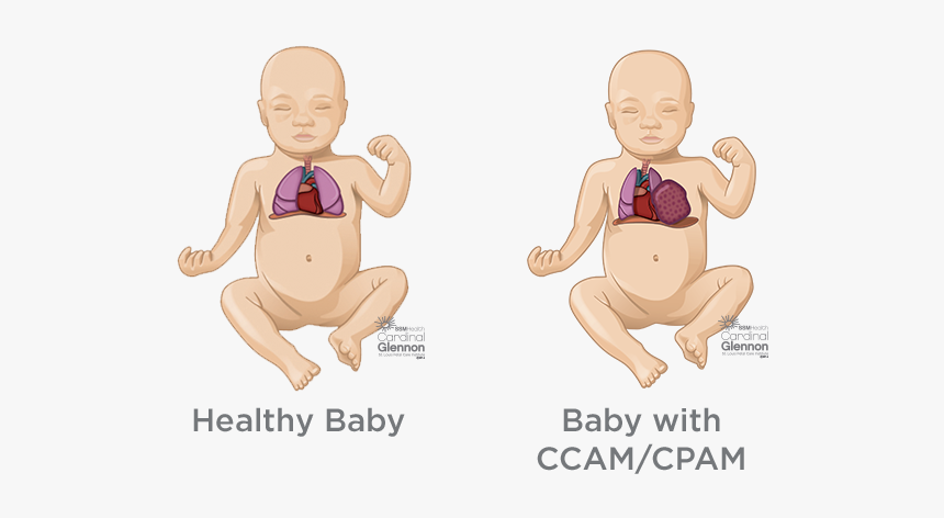 Bladder Outlet Obstruction, HD Png Download