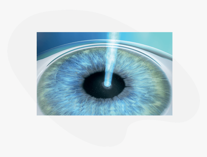 Prk Treatment With Excimer Laser Bandage Contact Lens After Prk, HD