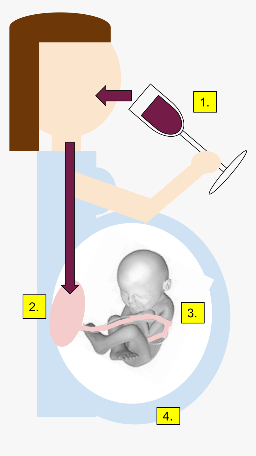 Fetal Alcohol Syndrome Gif, HD Png Download