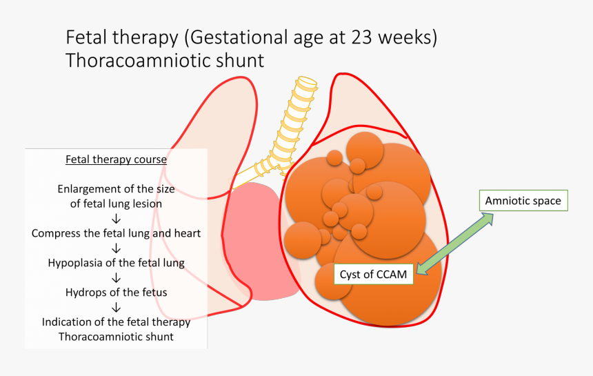Successful Treatment For A Severe Case Of Fetal Lung - 先天 性 嚢胞 性 腺腫 様 奇形, HD Png Download