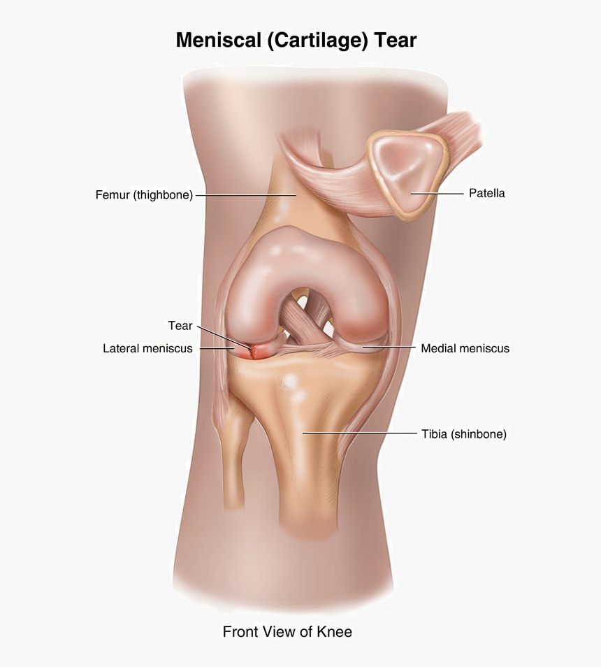 Can A Torn Meniscus Heal Itself - Loose Cartilage In Knee, HD Png Download