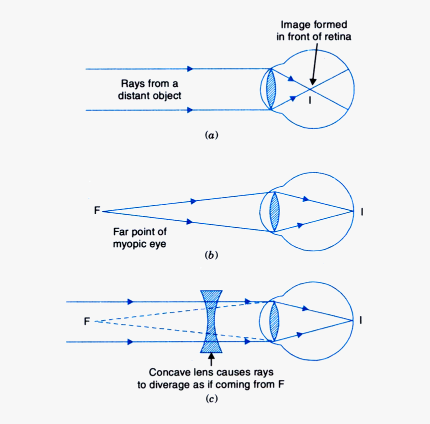 Transparent Human Eyes Png - Correction Of Myopic Eye, Png Download
