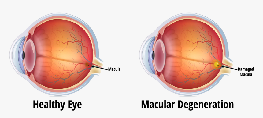 Blindness Caused By Glaucoma, HD Png Download