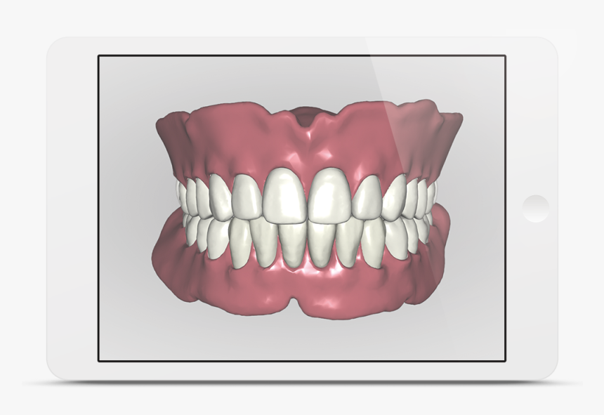 Avadent Ipad - 3d Gebitsprothese, HD Png Download