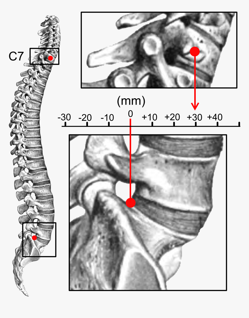 Sagittal Balance - Kyphosis, HD Png Download